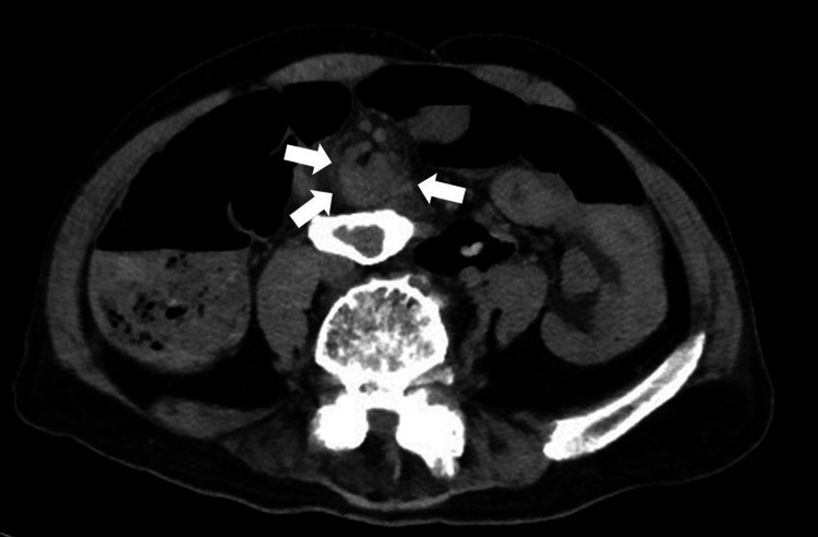 Tomografía computada axial de abdomen sin contraste que muestra el signo del remolino mesentérico en el sigmoides