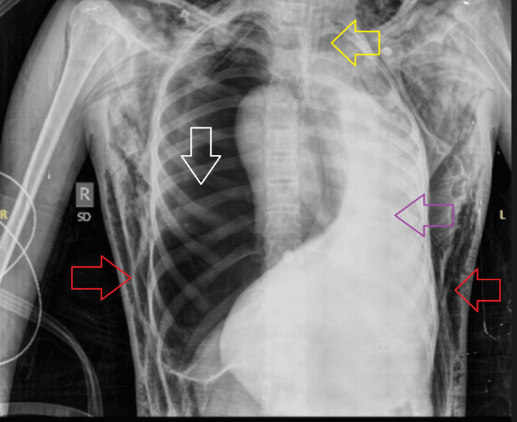 Radiografía de tórax anteroposterior: hemitórax derecho hiperlúcido sin trama vascular, desplazamiento mediastínico contralateral, enfisema subcutáneo y tubo endotraqueal in situ